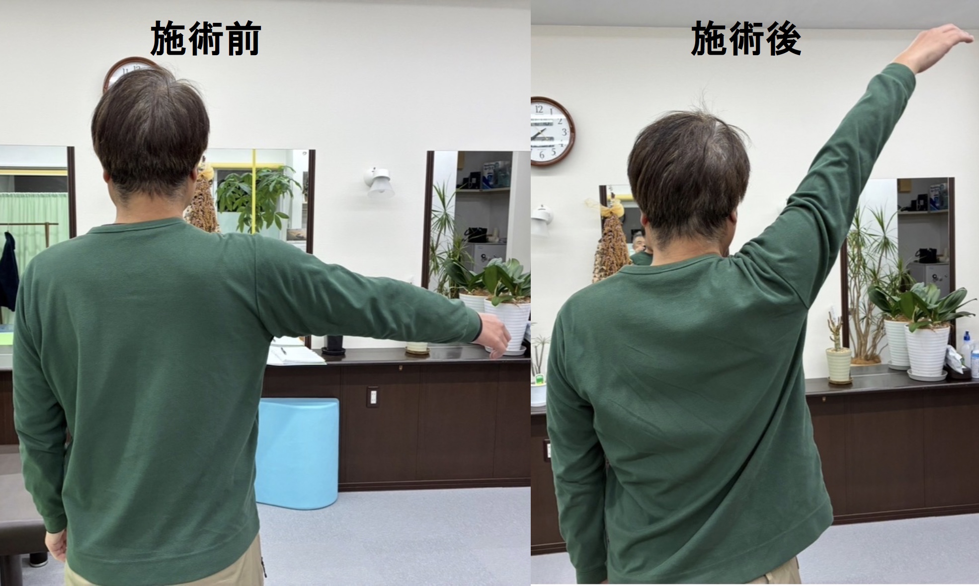 【施術レポ】【肩が挙がらない!】バレーボールで痛めた肩の改善例✨