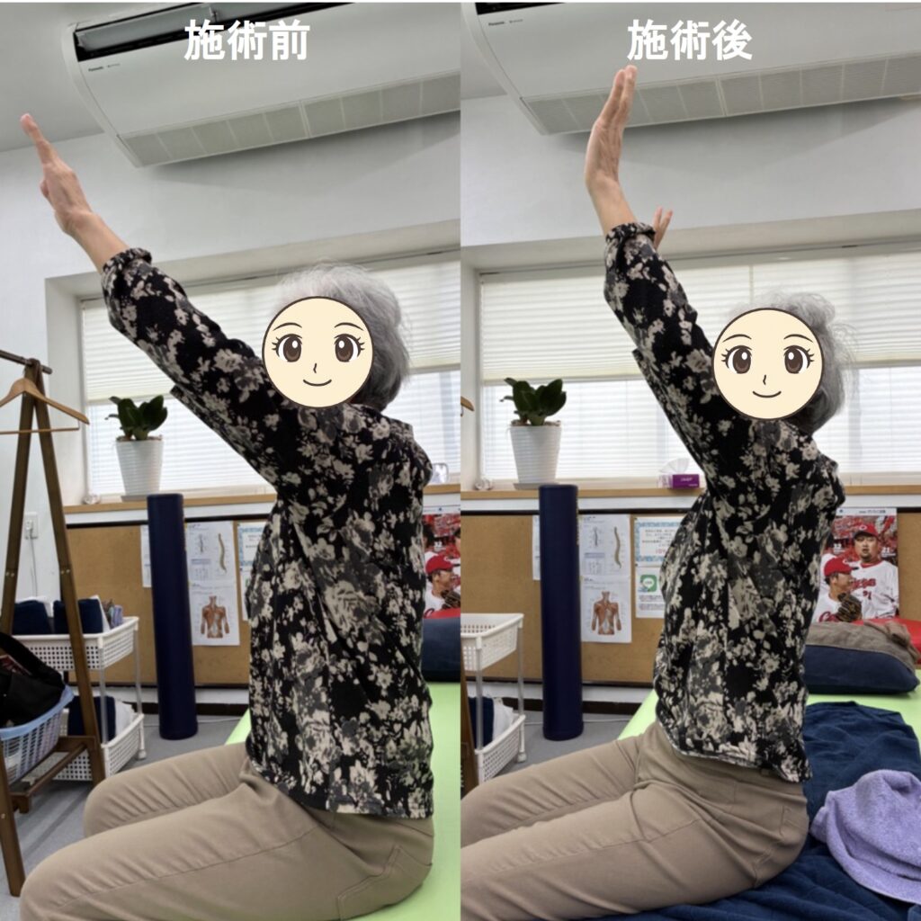 🌿【施術例】80代女性：肩が挙がりにくい、首こりでご来店